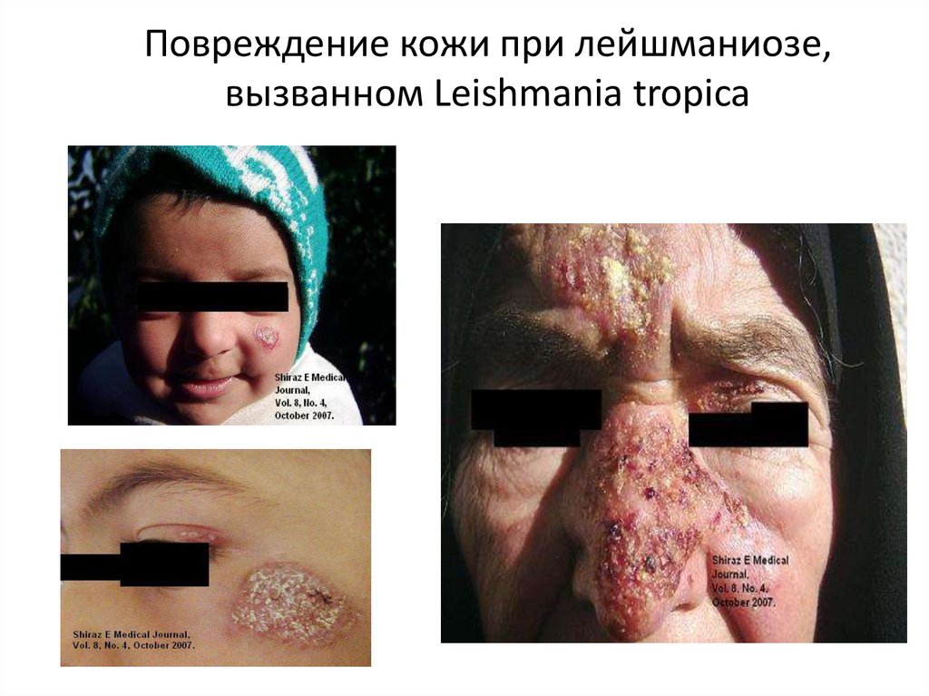Повреждение кожи при лейшманиозе, вызванном Leishmania tropica