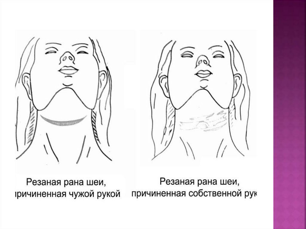 Колото режущих. Колото-резаная рана шеи. Резаная рана судебная медицина.