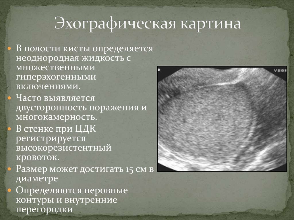 Полость в эндометрии. УЗИ при хроническом эндометрите. Множественные гиперэхогенные включения в матке. Образование в полости матки. Хронический эндометрит УЗИ картина.