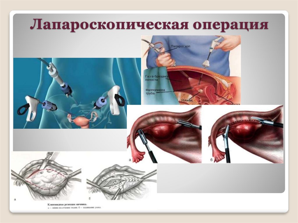 Холецистэктомия этапы операции