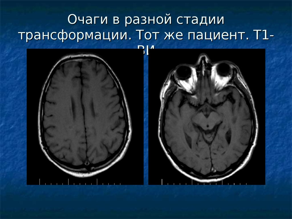 Демиелинизирующие заболевания презентация