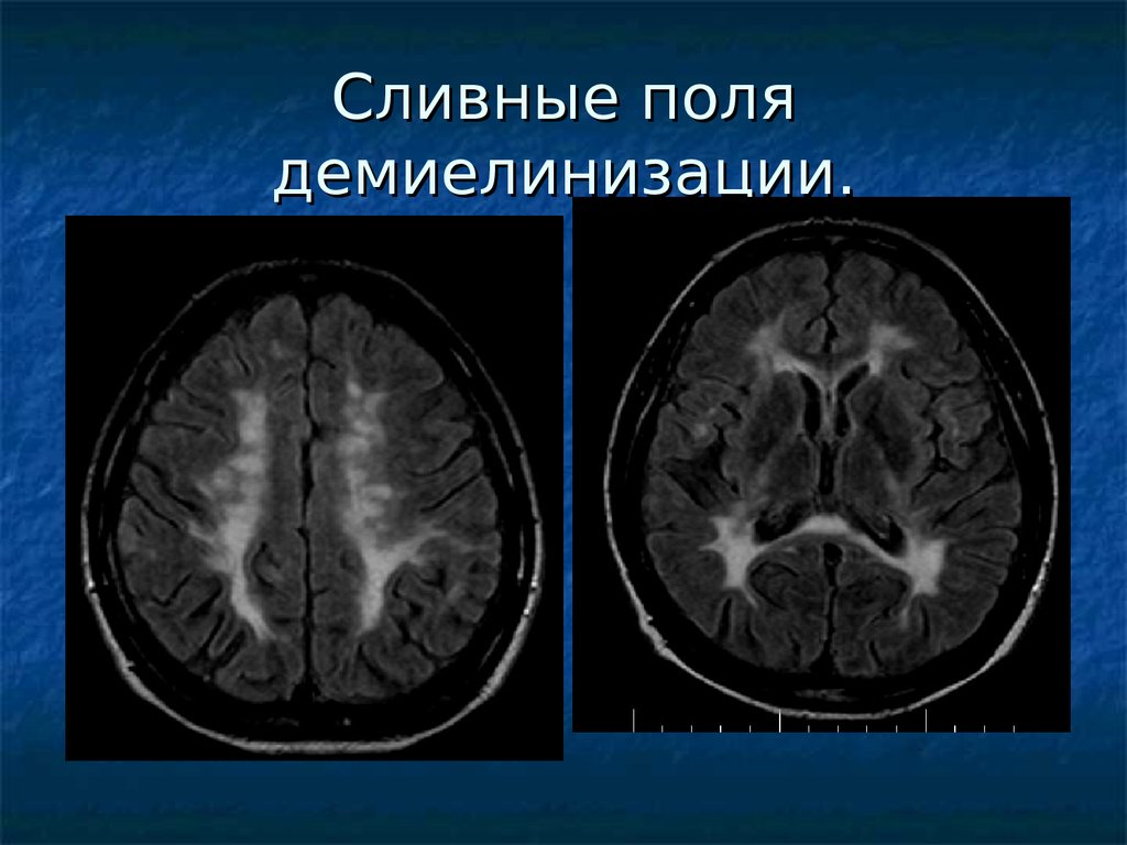 Демиелинизация. Демиелинизирующее поражение ЦНС. Демиелинизирующие заболевания нервной системы мрт. Демиелинизирующий процесс на кт головного мозга. Что такое демиелинизирующий склероз.