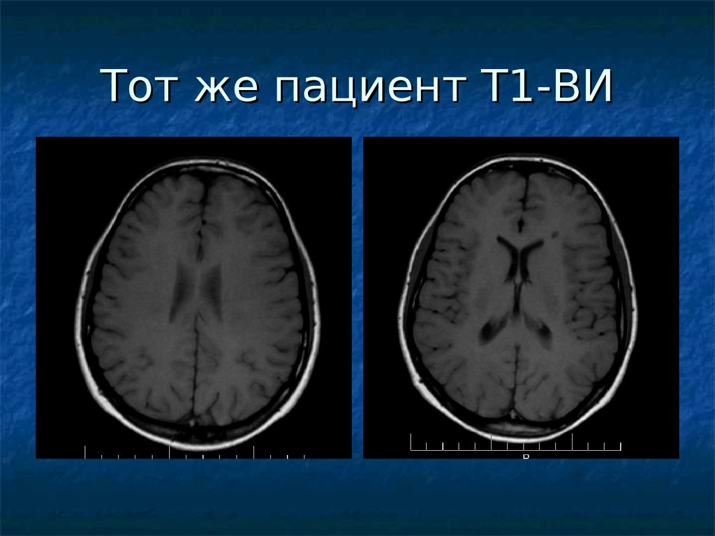 Рассеянный склероз демиелинизирующие заболевания. Демиелинизирующие заболевания ЦНС. Демиелинизирующими заболеваниями. Демиелинизирующее заболевание головного мозга у детей. Демиелинизирующие заболевания симптомы.