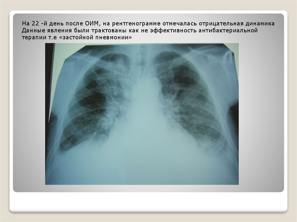 Гипостатические изменения в легких. Застойная пневмония рентген. Застойная пневмония рентгенограмма. Гипостатическая пневмония рентген.