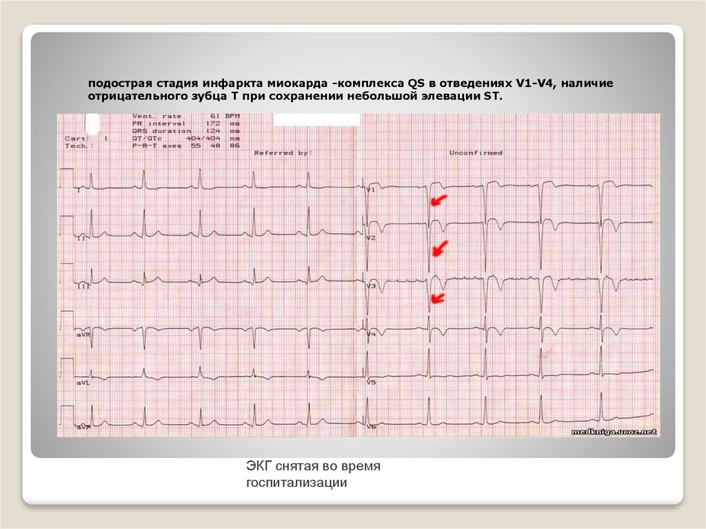 Отведение v1 на экг. Подострая стадия инфаркта на ЭКГ. Подострая стадия инфаркта миокарда на ЭКГ. Подострый период инфаркта миокарда на ЭКГ. Подострый инфаркт ЭКГ.