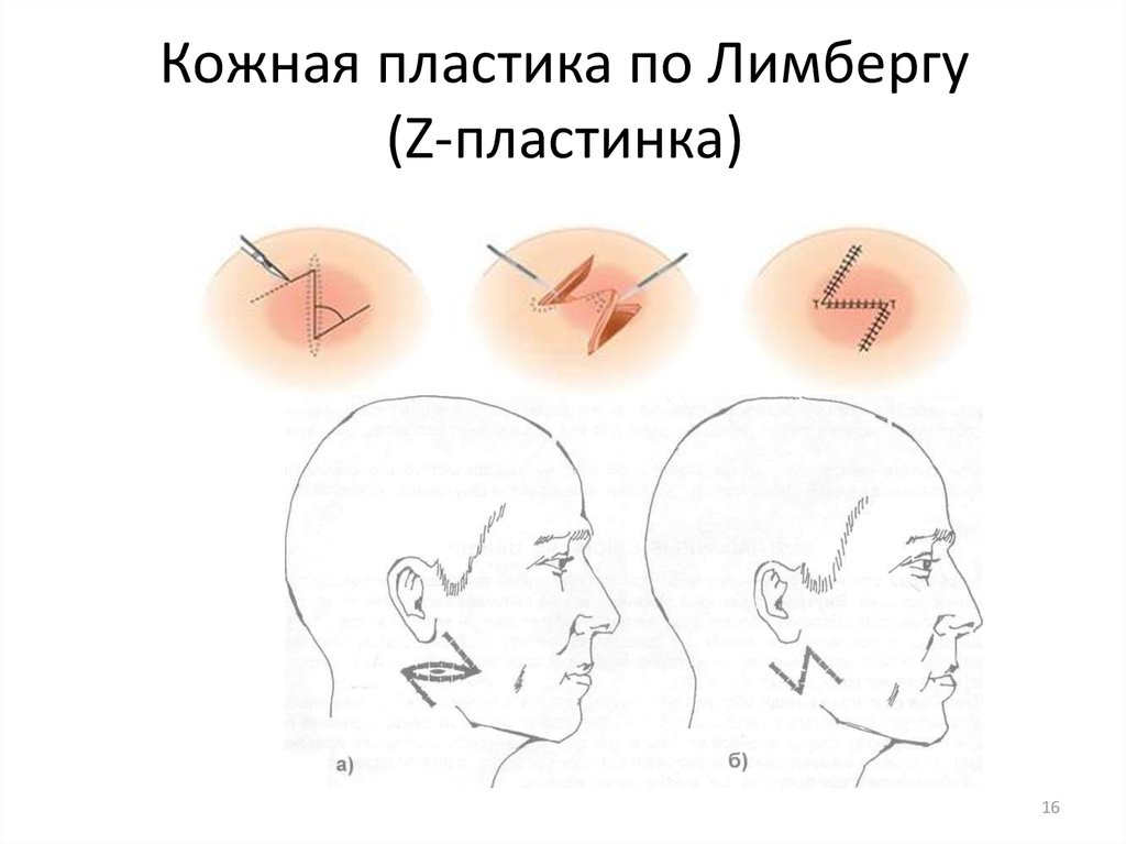 Пластика кожи. Пластика по Лимбергу встречными лоскутами. Лоскут по Лимбергу. Способ Лимберга кожная пластика. Z образная пластика по Лимбергу.