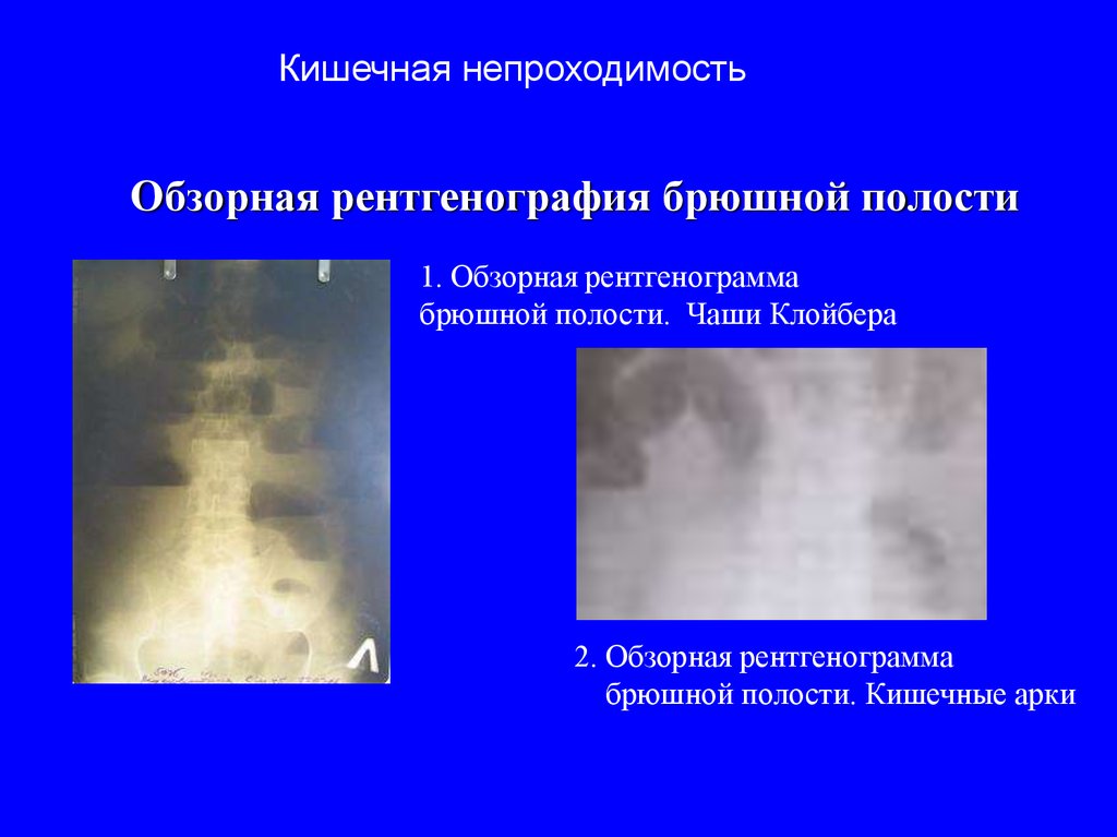 Обзорная рентгенография брюшной полости. Кишечная непроходимость чаши Клойбера. Чаши Клойбера при толстокишечной непроходимости. Чаши Клойбера рентген описание. Рентгенограмма брюшной полости при кишечной непроходимости.