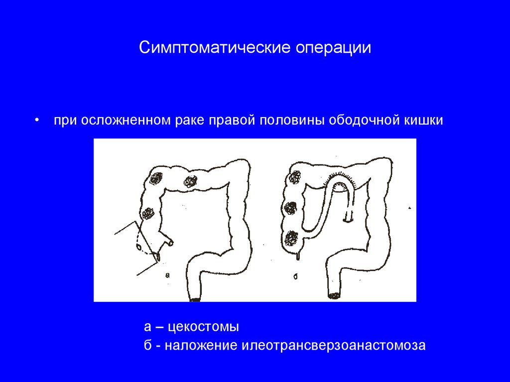 Операция лахея схема