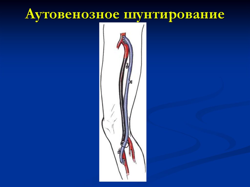 Операция шунтирование нижних. Бедренно-подколенное шунтирование. Аорто подвздошное шунтирование. Аутовенозное шунтирование нижних конечностей. Шунт бедренной артерии.