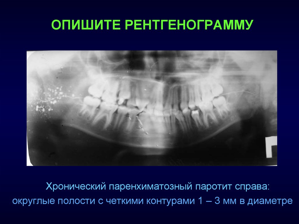 Паротит хронический. Паренхиматозный сиалоаденит. Хронический паренхиматозный паротит. Хронический рецидивирующий паренхиматозный паротит. Хронический неспецифический паренхиматозный паротит рентген.