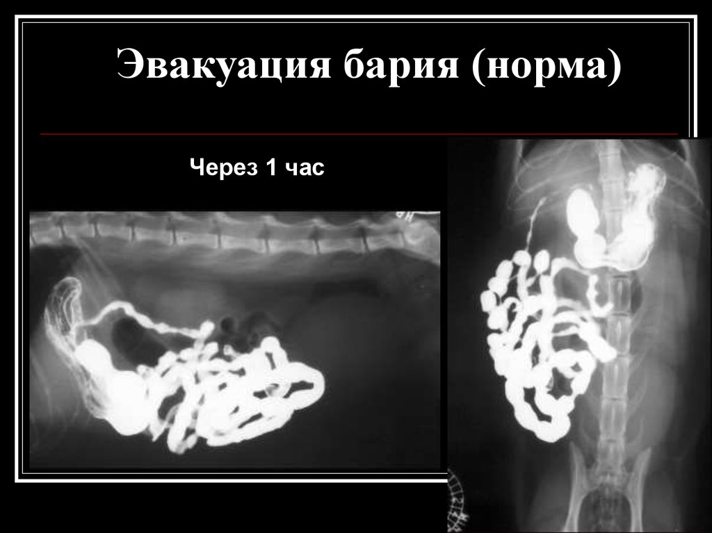 Больница барий. Рентгенография с барием норма.