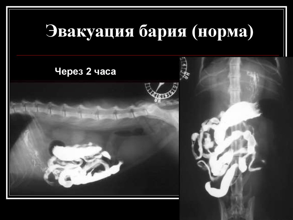 Прием бария. Контрастная рентгенография тонкой кишки Пассаж бария. Пассаж бария по кишечнику рентген. Пассаж бария по кишечнику.