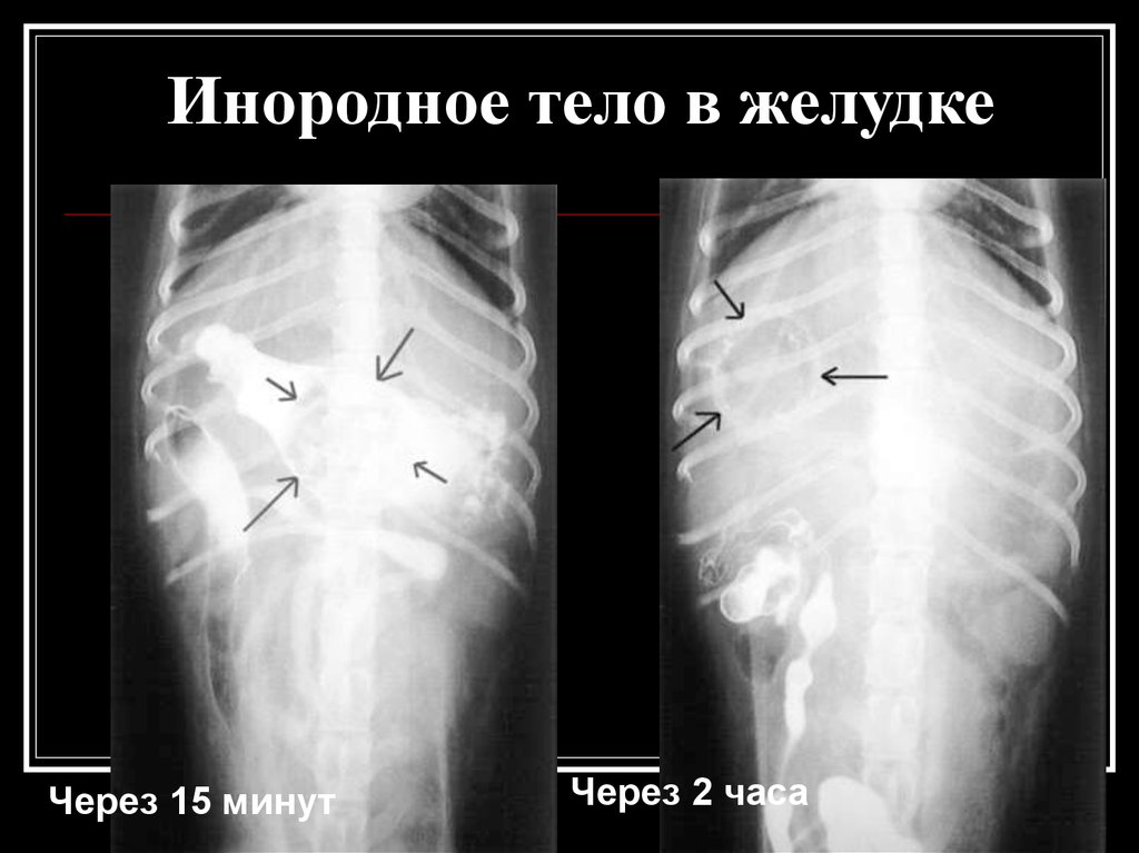 Инородное тело. Посторонний предмет в желудке. Рентген инородное тело в ЖКТ.