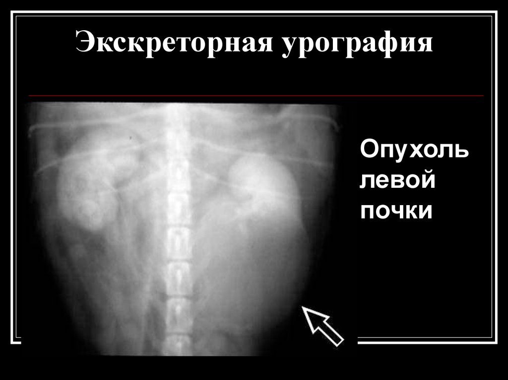 Опухоль левой. Экскреторная урография опухоль почки. Урография опухоль почки. Опухоль Вильмса экскреторная урография. Опухоль левой почки экскреторная урография.