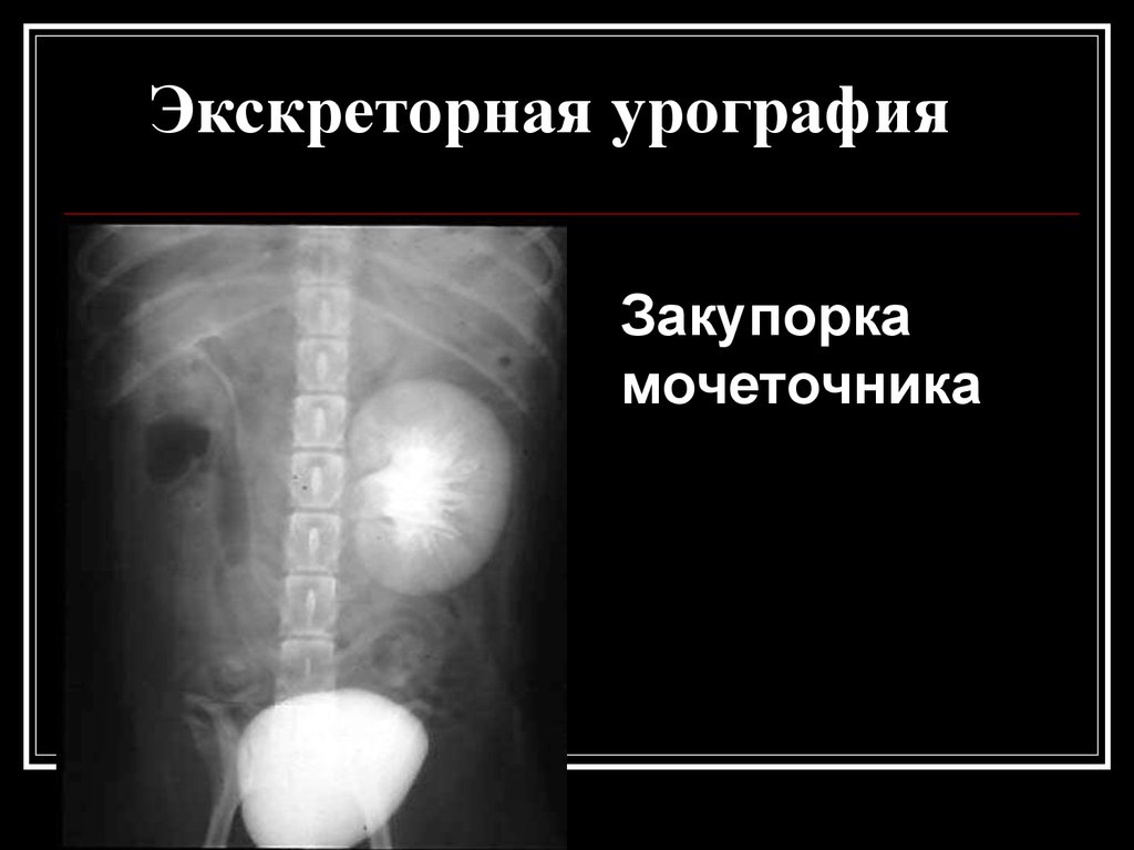 Обструкция мочеточника. Экскреторная урография камень мочеточника. Экскреторная урография непроходимость мочеточника. Экскреторная и ретроградная урография. Обструкция мочеточника урография.