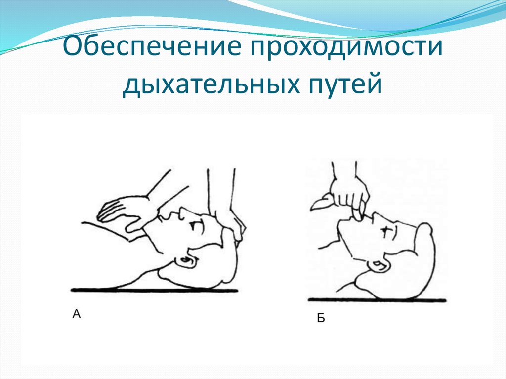 Признаки жизни и проходимости дыхательных путей. Обеспечение проходимости дыхательных путей. Обеспечить проходимость дыхательных путей. Обеспечение свободной проходимости дыхательных путей. Способы обеспечения проходимости дыхательных путей.