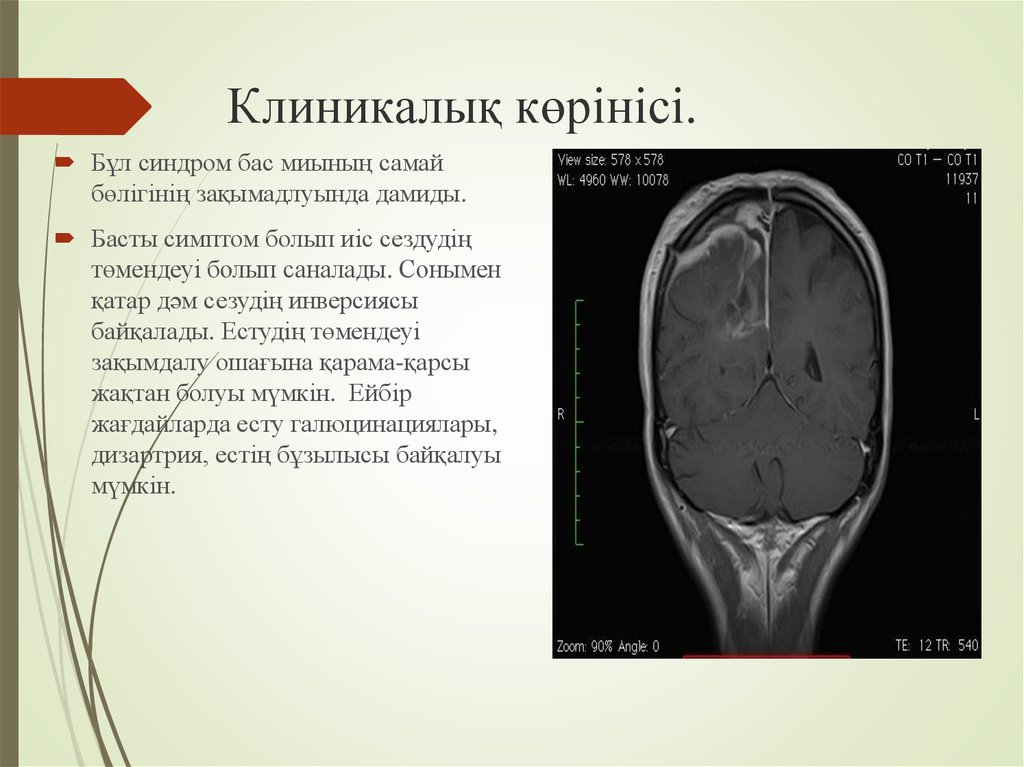 Синдром бокового амиотрофического склероза. Бас боковой амиотрофический склероз. Боковой амиотрофический склероз.