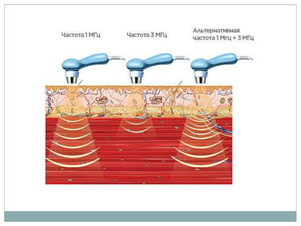 Ультразвуковая терапия презентация