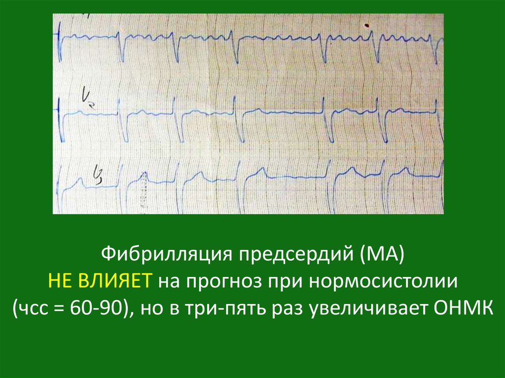 Пароксизмальная фибрилляция предсердий