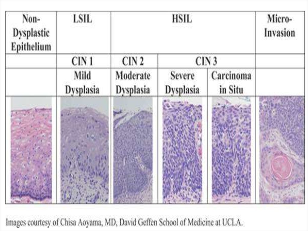 Cin iii. Плоскоклеточное интраэпителиальное поражение высокой степени.