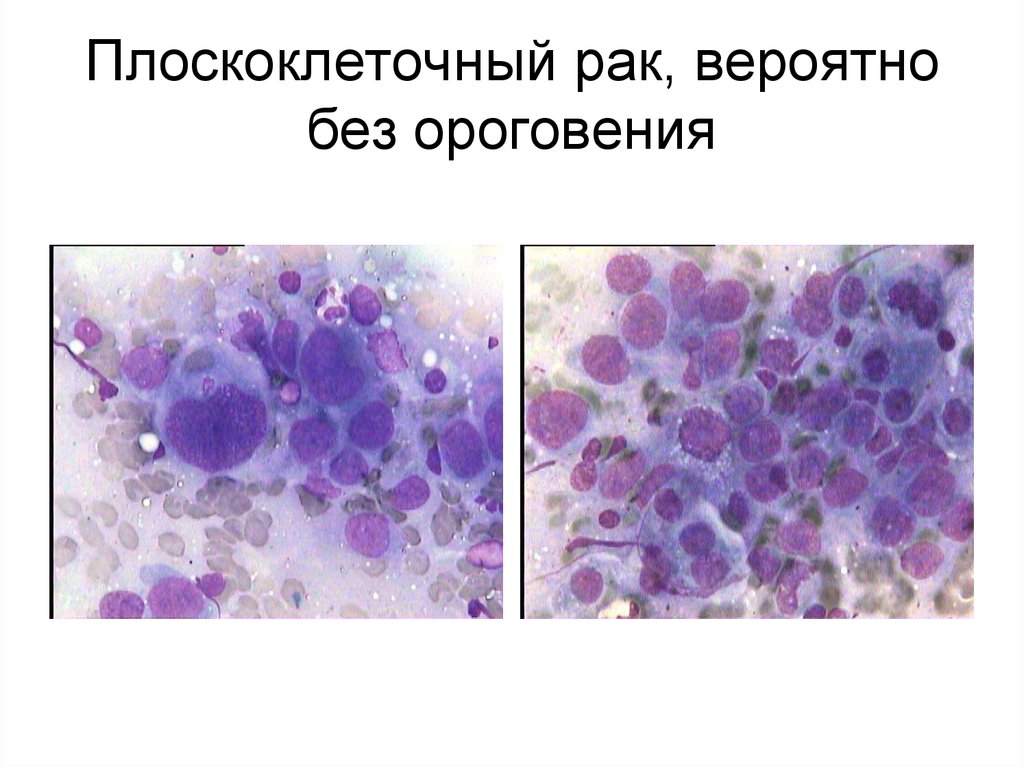 Цитологическая картина плоскоклеточного рака шейки матки