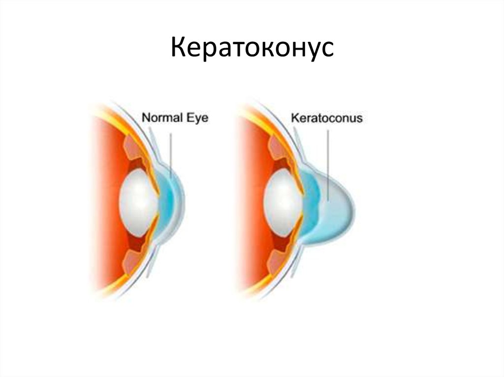 Кераринг. Кросс-линкинг. Кератоконус - презентация онлайн