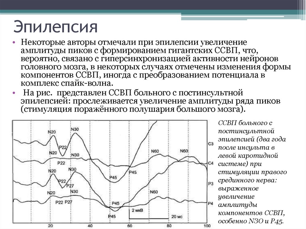 Частота эпилепсии. Соматосенсорные вызванные потенциалы. Вызванные потенциалы при эпилепсии. Соматосенсорные вызванные потенциалы (ССВП). Соматосенсорные вызванные потенциалы с рук.