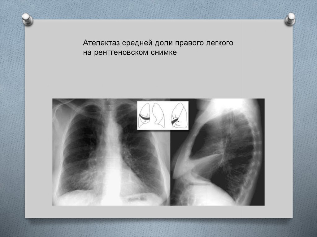 Доле правого. Ателектаз средней доли правого легкого рентген. Дисковидный ателектаз рентген. Синдром ателектаза рентген. Компрессионный ателектаз рентгенограмма.