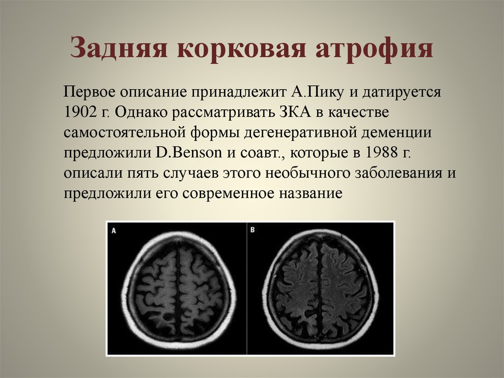 Атрофия мозга симптомы. Задняя корковая атрофия. Кортикальная атрофия головного мозга кт. Кортикальная атрофия мозга на кт.