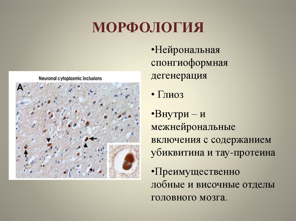 Липофусциноз. Глиоз головного мозга гистология. Нейрональный цероидный липофусциноз.