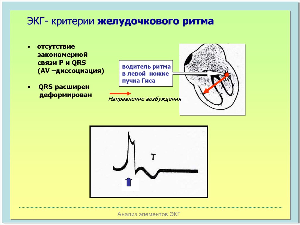 Желудочковый ритм. Желудочковый водитель ритма ЭКГ. Ритм желудочковый на кардиограмме. Желудочковый ритм на ЭКГ норма. Критерии желудочкового ритма.