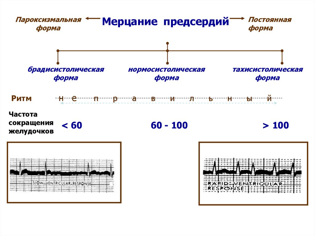 Диагноз постоянная форма предсердий