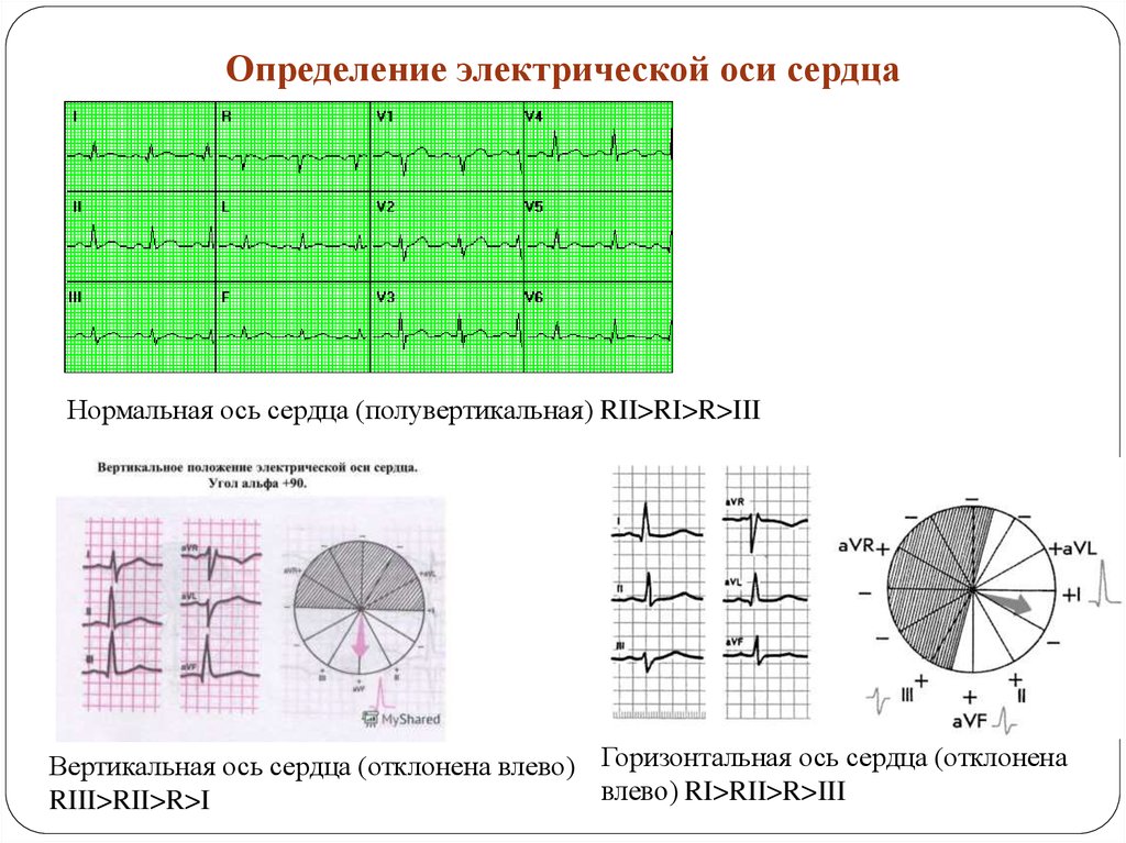 Эос экг что значит. Определение положения ЭОС по ЭКГ. Положение электрической оси сердца на ЭКГ. ЭКГ при вертикальной ЭОС. ЭКГ вертикальное положение электрической оси.