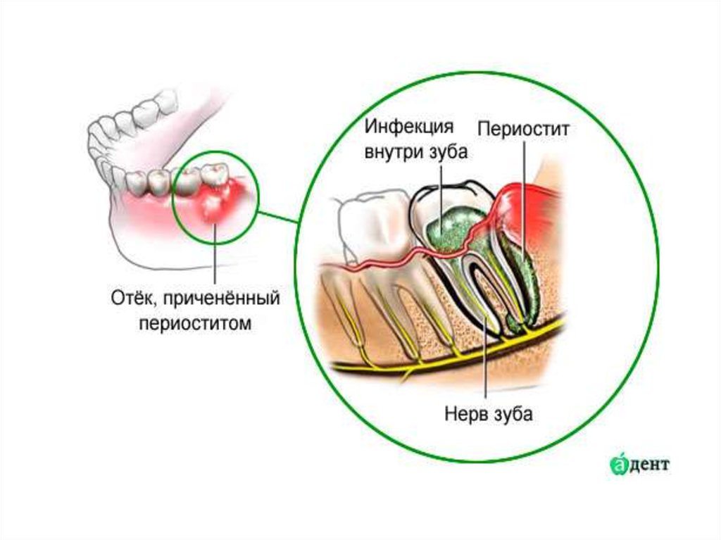 Периостит клиническая картина