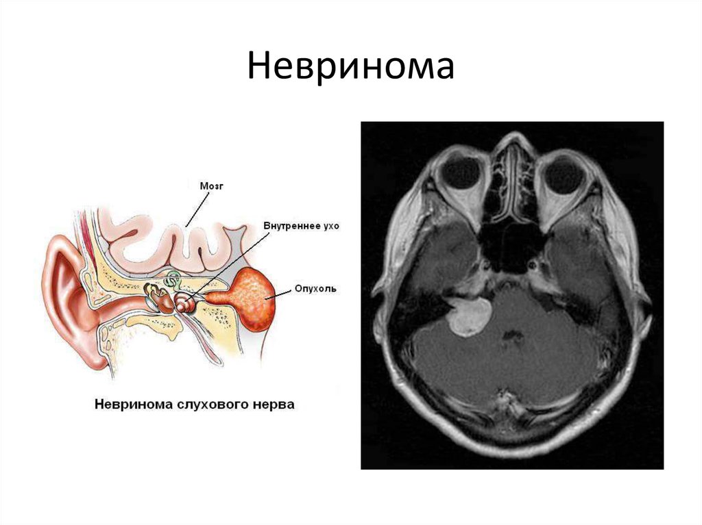 Слуховой нерв в мозге. Невринома преддверно-улиткового нерва дифференциальная. Кт мрт с невриномой слухового нерва. Акустическая невринома опухоль слухового нерва.