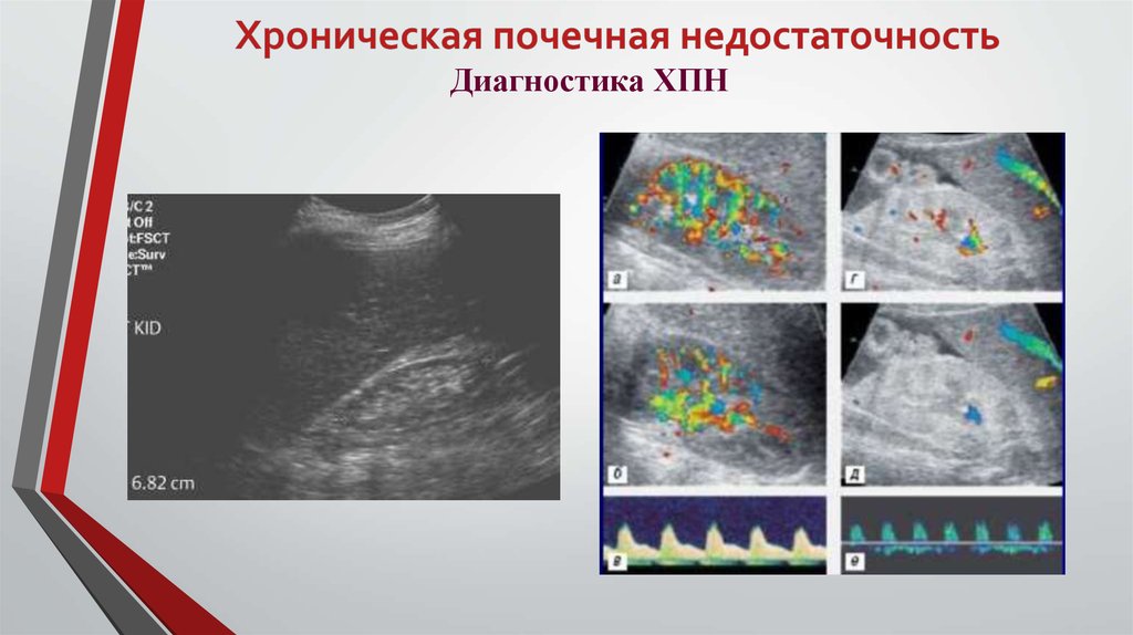 Хроническая почечная недостаточность диагностика. Острая почечная недостаточность УЗИ. Хроническая болезнь почек на УЗИ.