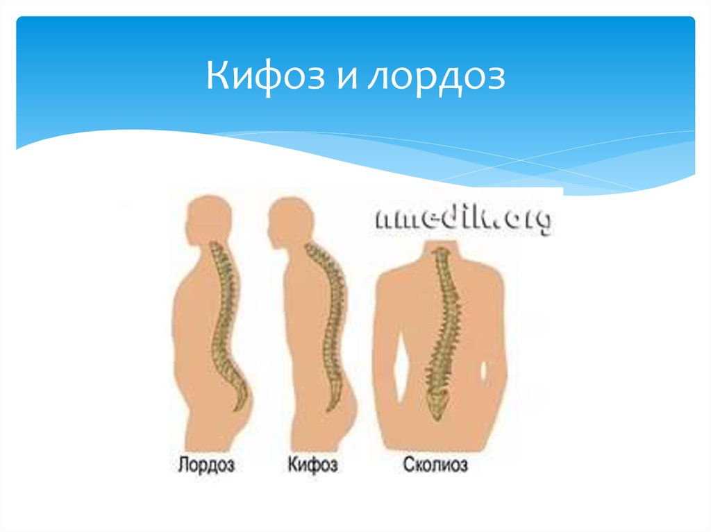 2 кифоза. Изгибы позвоночника лордоз и кифоз сколиоз. Кифоз сколиоз лордоз отличия. Кифоз лордоз кифоз. Лордоз и кифоз фото.