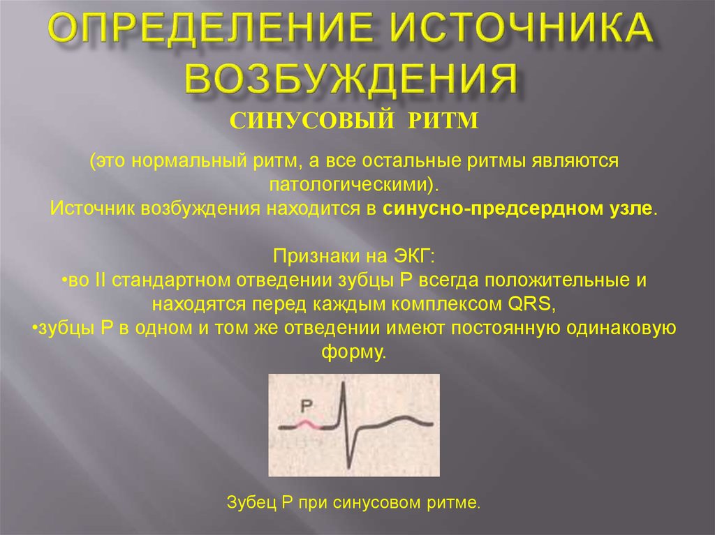 Определение источника возбуждения водителя ритма