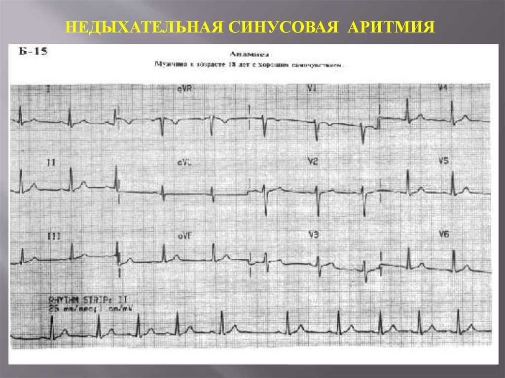 Аритмия на экг. Недыхательная синусовая аритмия на ЭКГ. ЭКГ критерии синусовой аритмии. ЭКГ при синусовой аритмии. Синусовая аритмия на ЭКГ.