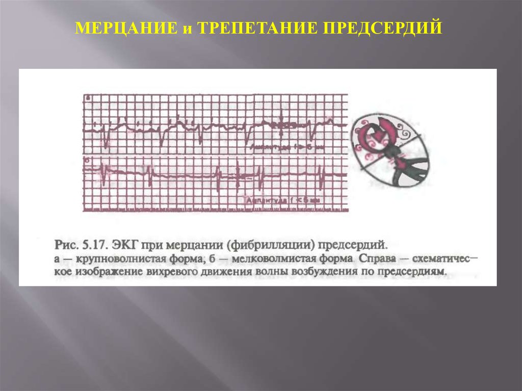 Трепетание предсердий на экг