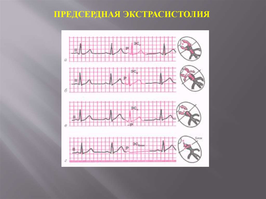 Экг предсердный. Экстрасистолия предсердий на ЭКГ. Предсердная экстрасистолия на ЭКГ. Экстрасистола предсердия на ЭКГ. Предсердная экстрасистолия экстрасистолия ЭКГ.