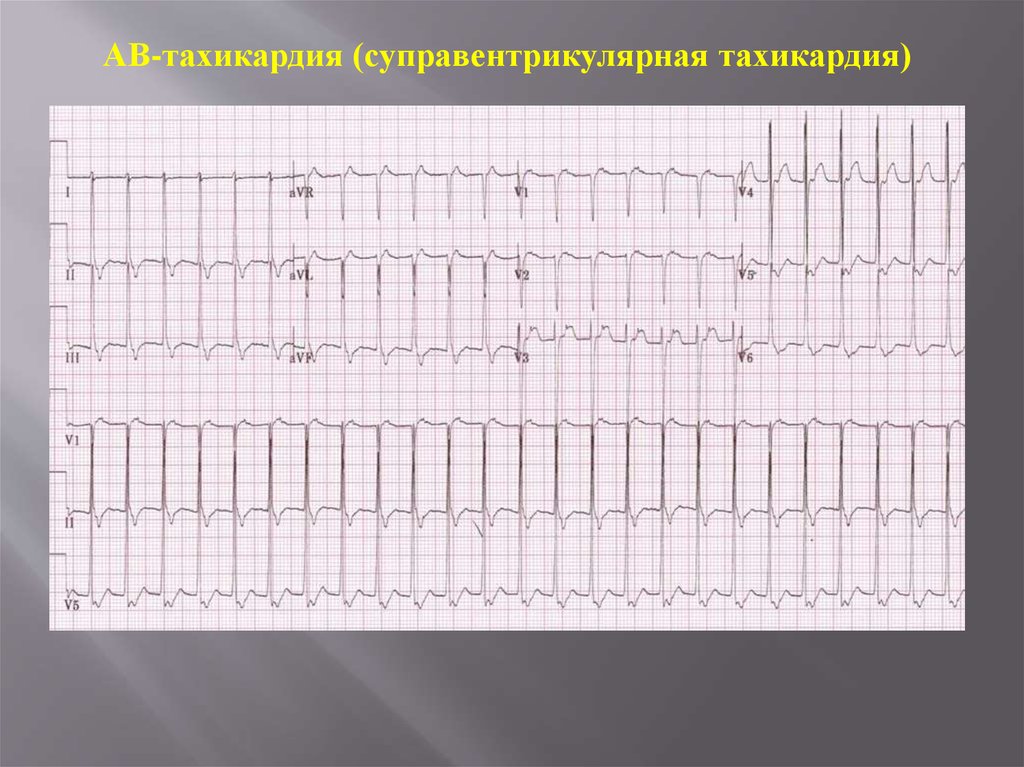 Тахикардия на экг