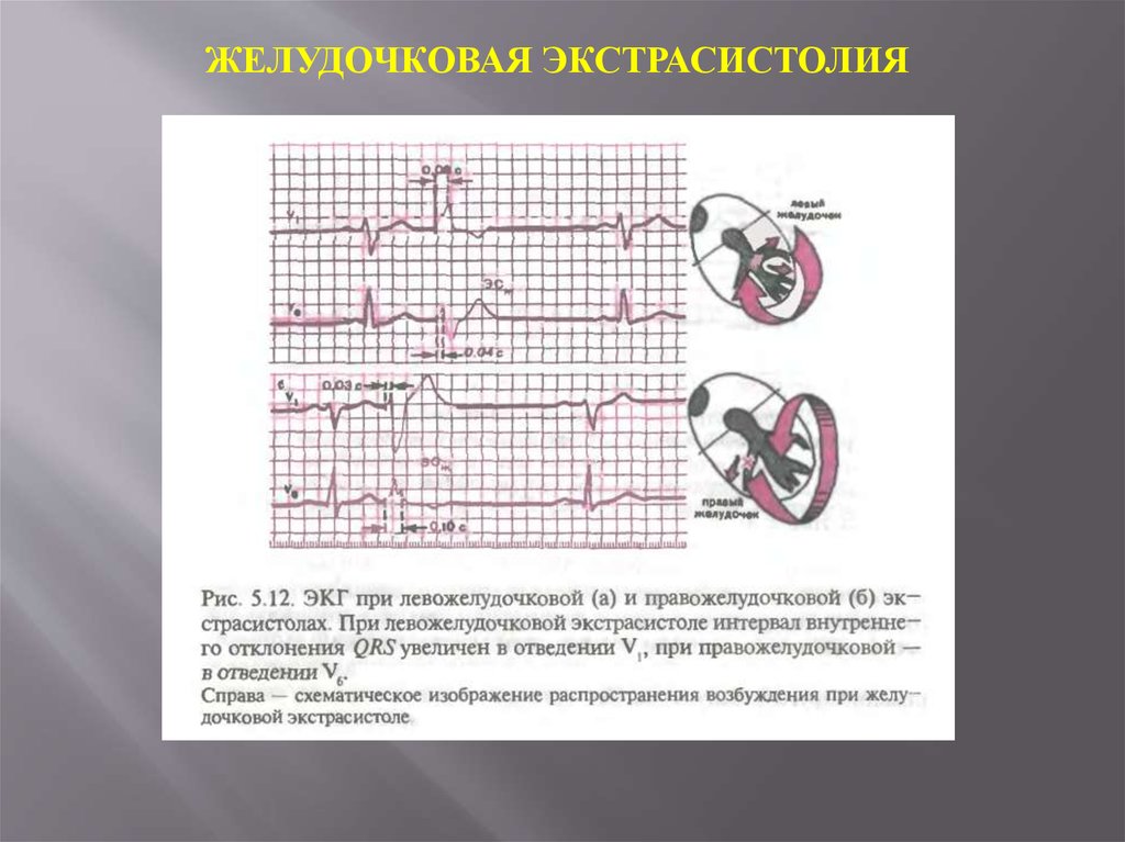 Экстрасистола желудочков. Левожелудочковая экстрасистолия на ЭКГ. Экстрасистола желудочков на ЭКГ. Желудочная экстрасистолия на ЭКГ. Желудочковая экстрасистолия на ЭКГ.