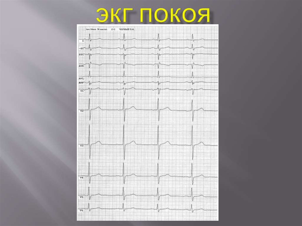 Экг в покое. Электрокардиография в покое. Электрокардиография в поко. Электрокардиограмма в покое и после нагрузки.