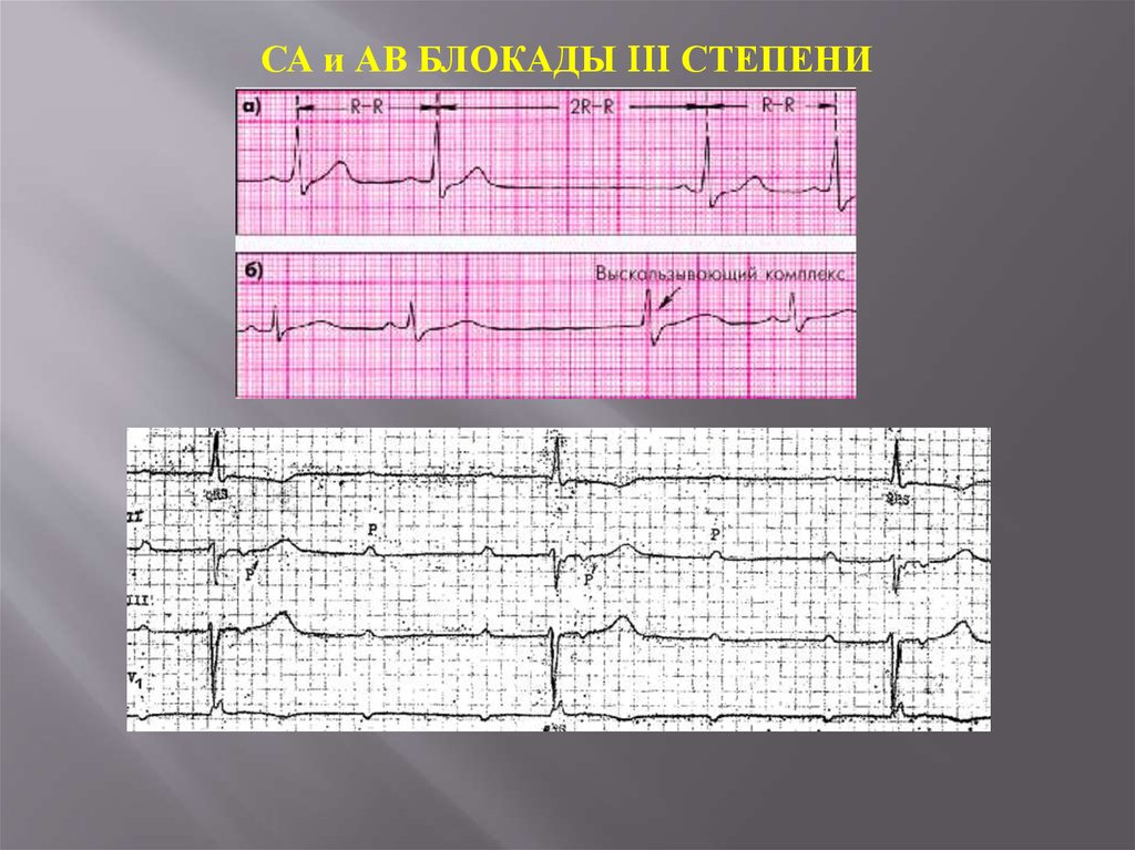 Экг 3. Критерия са блокады 3 степени на ЭКГ. Av-блокада II И III степени, синоатриальная блокада.