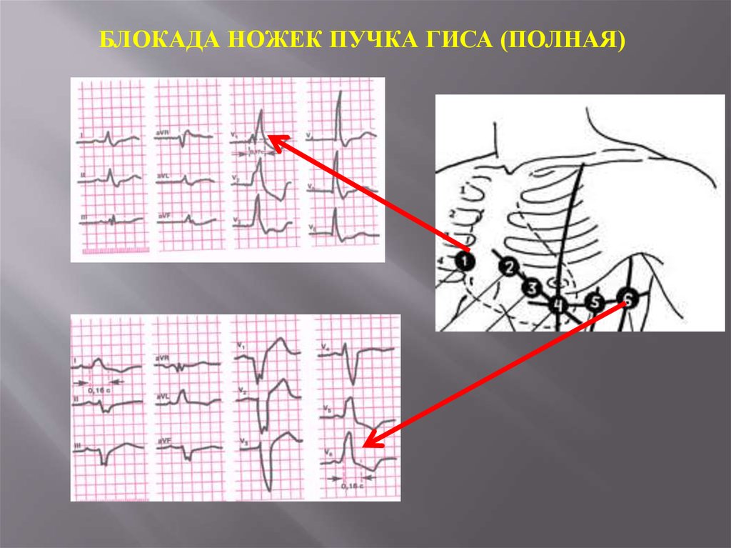 Нарушение ножки гиса