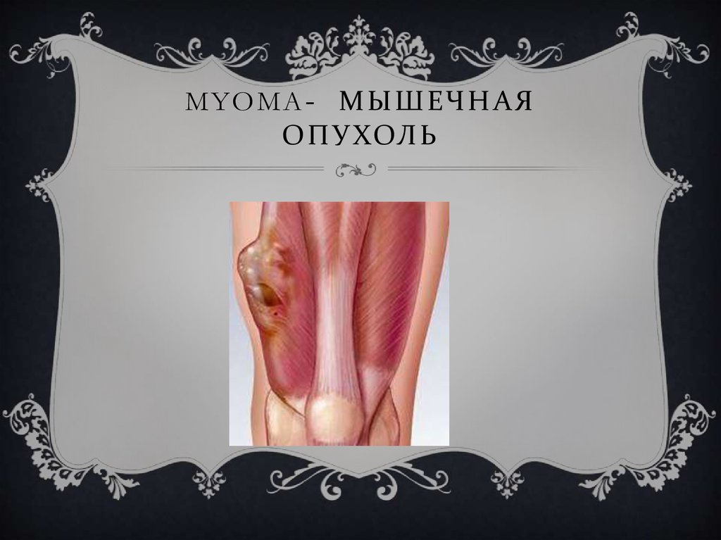myoma- Мышечная опухоль