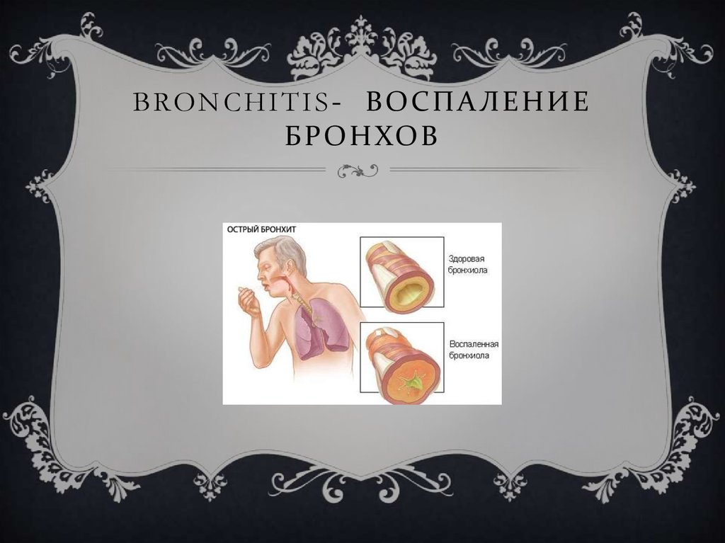 bronchitis- Воспаление бронхов
