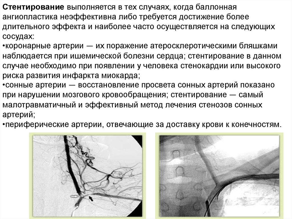 Инвалидность при стентировании. Ангиопластика почечных артерий. Ангиопластика артерий нижних конечностей. Стентирование периферических артерий. Баллонная ангиопластика артерий нижних конечностей.
