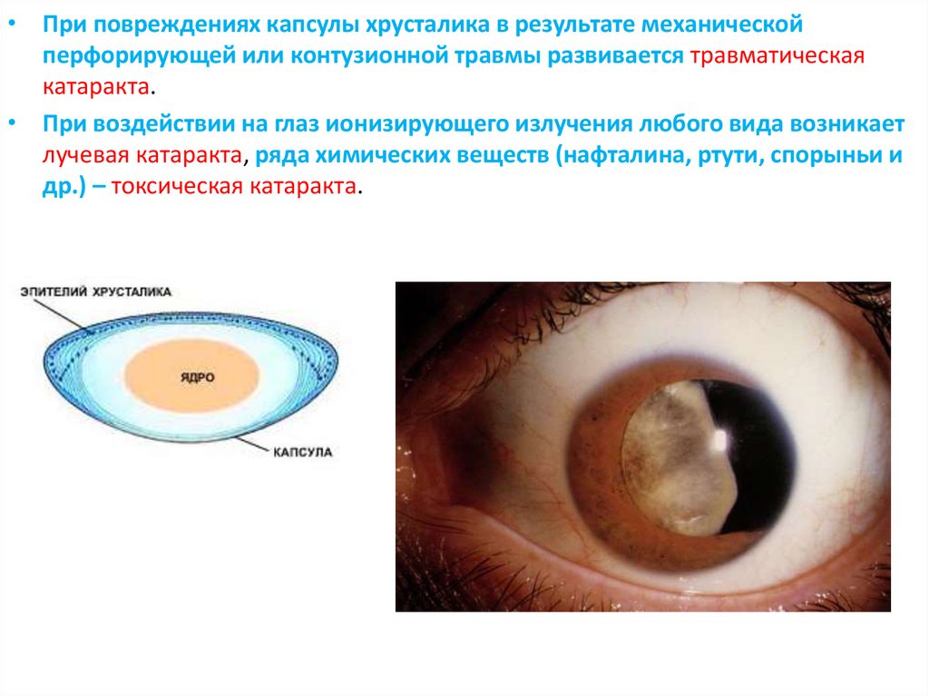 Травматическая катаракта. Катаракта развивается вследствие повреждающего действия излучения. Утолщение капсулы хрусталика. Как выглядит травматическая катаракта.